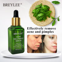 BREYLEE Acne Treatment Serum 17 ml