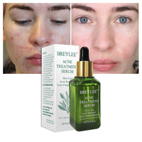 BREYLEE Acne Treatment Serum 17 ml